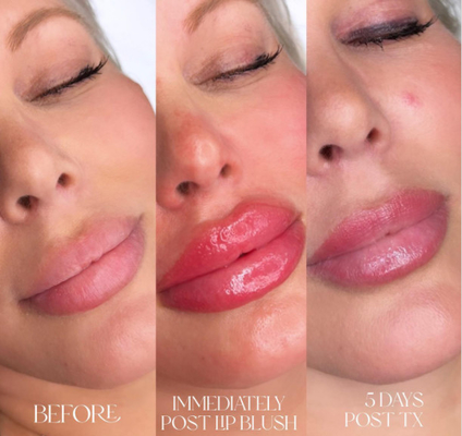 Skinject Deep Hyaluronic Acid Dermal 2ml Lips Fillers عن طريق الحقن