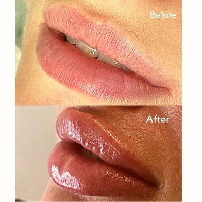 حقن Filler Injection Juvederms Ultra 3 HA Dermal Filler لحجم الشفاه