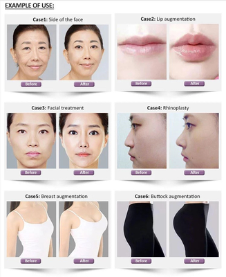 Revolax Fine Deep Sub-Q Hyaluronic Acid Cross Linked Dermal Filler 1.1ml