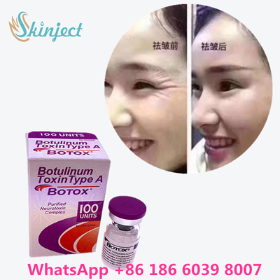 البوتولينوم توكسين البوتوكس لإزالة التجاعيد 100u Allergan 100 وحدة لحقن شد الوجه
