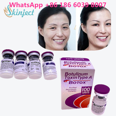 البوتولينوم توكسين البوتوكس لإزالة التجاعيد 100u Allergan 100 وحدة لحقن شد الوجه