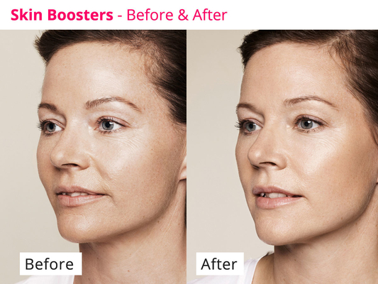 Hyamely Skin Regeneration يحفز مصل الكولاجين PDRN السائل الشفاف