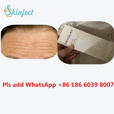 Hyaluronic Acid Dermal Revolax Deep Filler 1ml لحقن الشفاه