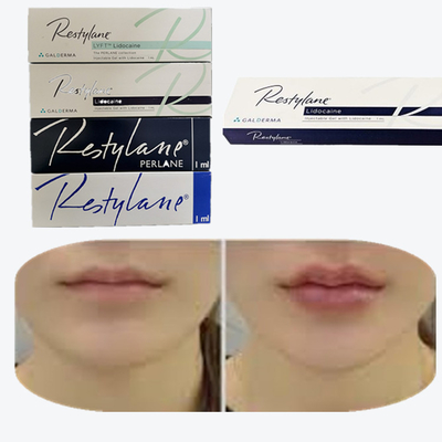 2*1ml/ Box Medical Sodium Hyaluronate Gel Filler Dermal للشفاه