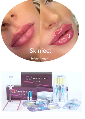 Juvederm حمض الهيالورونيك ملء جلد الوجه حقن 2*1ml تعبئة