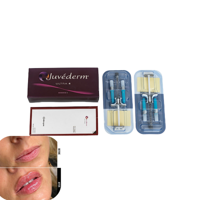 Juvederm حشوة جلدية لشفاه حقن حشوات حمض الهيالورونيك