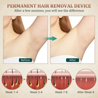 إزالة الحاجب إزالة الشعر ليزر آلة جمال 810nm ليزر إزالة الوشم
