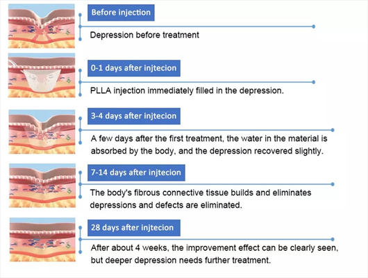 PLLA حمض بولي- L- لاكتيك حقن الوجه 10 أقراص 150mg
