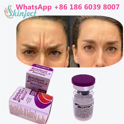توكسين البوتولينوم من النوع أ (Botox) التهاب الحساسية المصممة للطب والتجميل