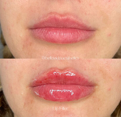 مدة الصلاحية 2 سنة جيل حقن لملء الجلد مصمم لتقليل التجاعيد