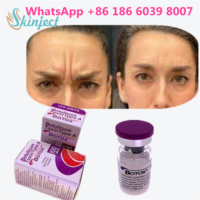 توكسين البوتولينوم بوتوكس التجميلي 100 وحدة أليرجان أونابوتولينوم توكسين أ للتجاعيد الوجهية