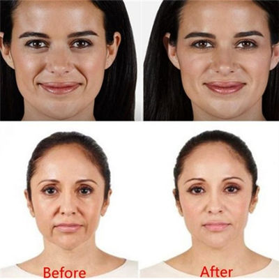 Juvaderm Voluma Hyaluronic Acid Pen Filler لتجاعيد عيون الجبين