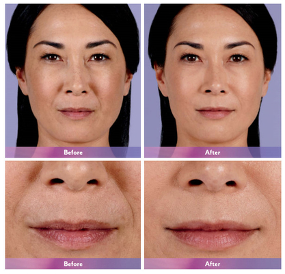Juvederm Dermal Filler Lip Injection Ultra 4 لتكبير الشفاه