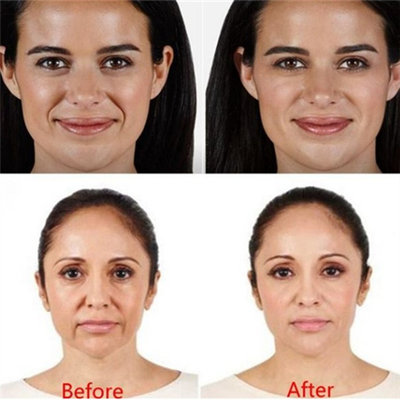 HA 2ml Dermal Filler Lip Injections حقن التجاعيد Juvederm