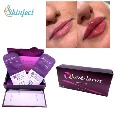 طيات Nasolabial Lips 2x1ml حشو جلدي حمض الهيالورونيك Juvederm Ultra3