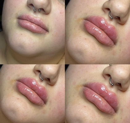 Revolax Deep HA Dermal Filler Lip Injections علامة CE