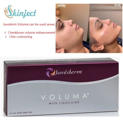 Juvederm Voluma 2x1ml حشو حمض الهيالورونيك الجلدي لعظم الخد