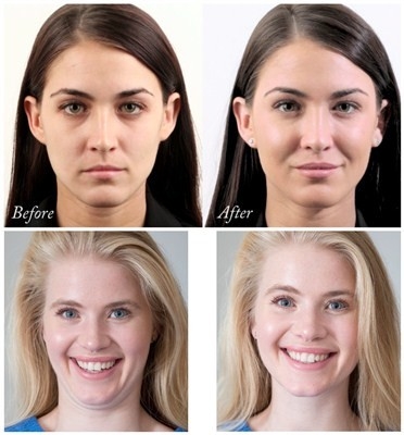 حشو الوجه بحمض الهيالورونيك Juvederms لتكبير الذقن والخد