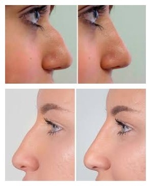 حشو الوجه بحمض الهيالورونيك Juvederms لتكبير الذقن والخد