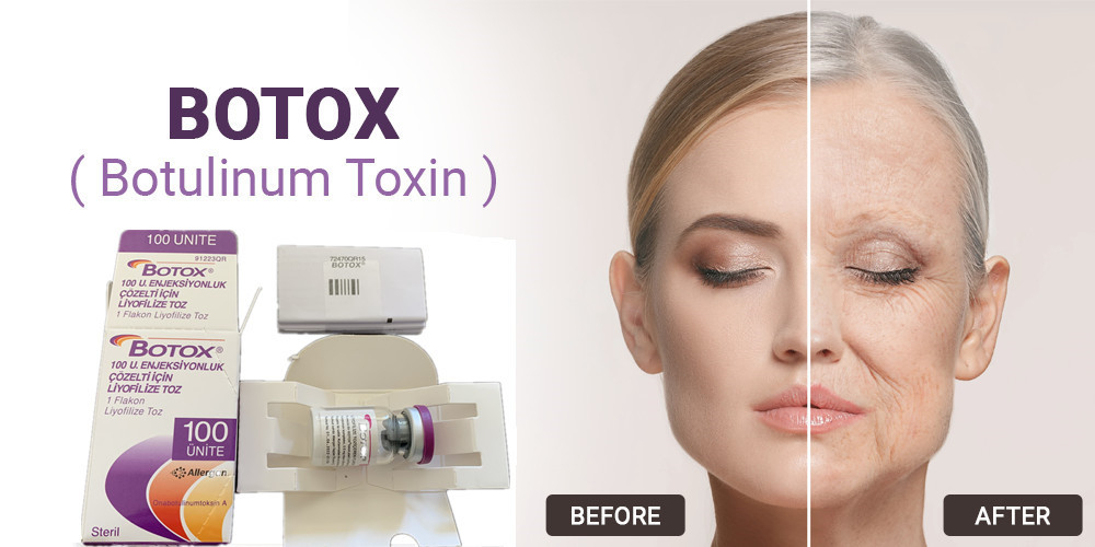 100 وحدة من Allergan Botulinum Toxin من النوع A حقن لإزالة تجاعيد الوجه