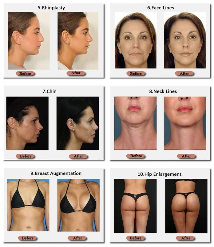 Skinjection 10 ml و 20 ml Hyaluronic breast Filler الكورية Technnology 24 Mg / Ml