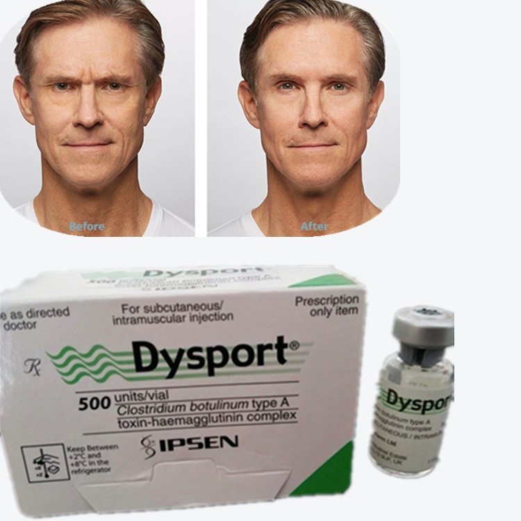 توكسين البوتولينوم Dysport 100IU توكسين البوتولينوم النوع A لإزالة التجاعيد