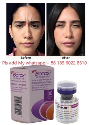 حقن توكسين البوتولينوم Allergan Botox 100IU - قلل علامات الشيخوخة مع Allergan